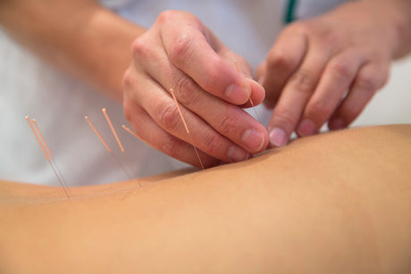 Acupuncture needles on back of a young woman