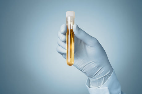 A gloved hand holds up a urine sample.